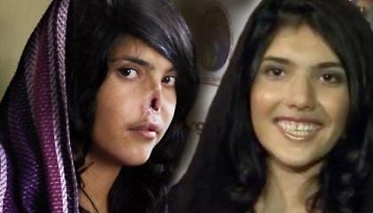 Το νέο πρόσωπο της 19χρονης που σόκαρε τον κόσμο