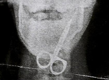 Κατάπιε ψαλίδι και τη γλίτωσε!