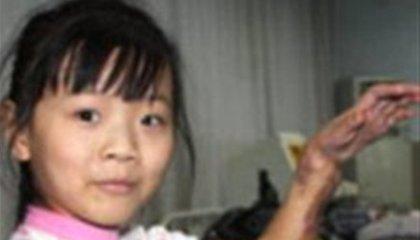 Μεταμόσχευσαν το χέρι στο πόδι 9χρονης