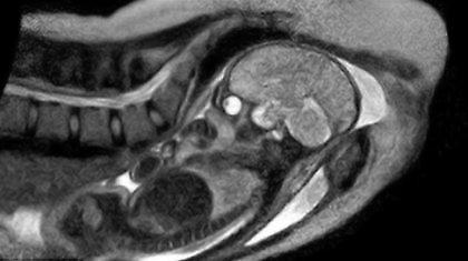 Ιστορική γέννα μέσα σε μαγνητικό τομογράφο!