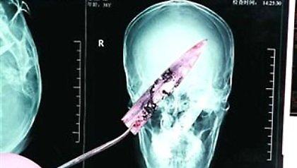 Ζούσε για 4 χρόνια με μια λεπίδα στο κεφάλι