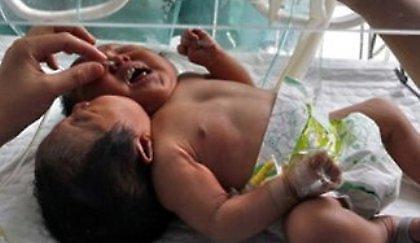 Παγκόσμια συγκίνηση για τα σιαμαία κοριτσάκια από την Κίνα