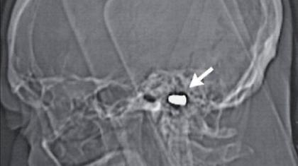 Ζει με σφαίρα στον εγκέφαλο του εδώ και 82 χρόνια