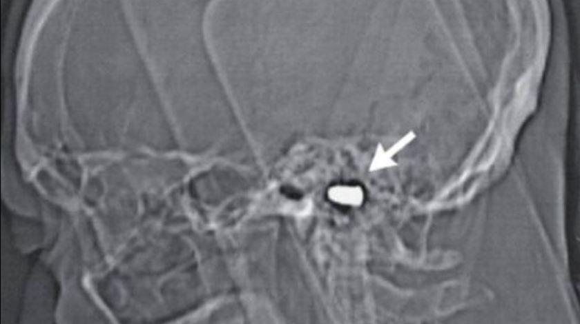 Ζει με σφαίρα στον εγκέφαλο του εδώ και 82 χρόνια