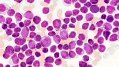 Πολέμησαν τη λευχαιμία με όπλο τον ιό HIV