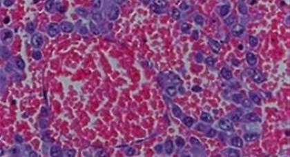 Κίνδυνος καρκίνου από φάρμακο που ρυθμίζει την αρρυθμία