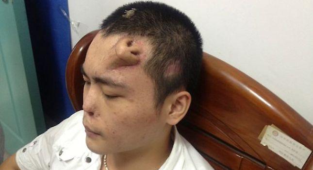 «Φύτρωσε» μύτη στο μέτωπο του!