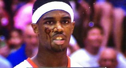 Έσκισε το πρόσωπο του σε προσπάθεια για κάρφωμα