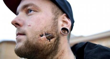 Σοκ: Ζούσε με ένα μπουκάλι κολλημένο στο πρόσωπο για 17 μέρες