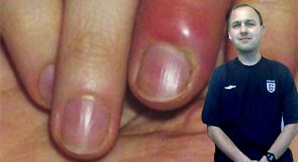 Πέθανε επειδή έτρωγε τα νύχια του!