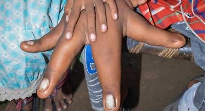 Αγόρι με γιγάντια χέρια! (pics)