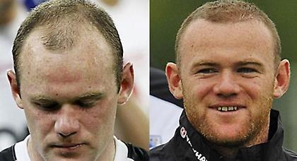 Rooney-Lebron: Αποτελέσματα μετά τη μεταμόσχευση μαλλιών FUE (video)