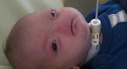 Μωρό γεννήθηκε χωρίς μύτη