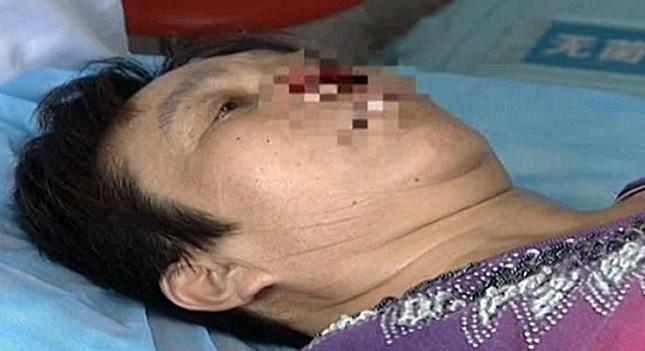 Δάγκωσε, έκοψε και κατάπιε τη μύτη της πρώην γυναίκας του (pics-vid)