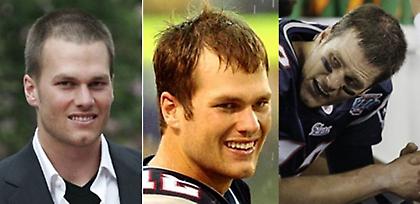 Μεταμόσχευση μαλλιών: Πώς εμπνέει ο Tom Brady