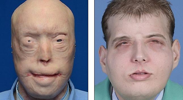 Μεταμόσχευση προσώπου σε ήρωα πυροσβέστη (pics)