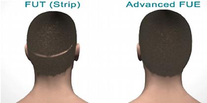 Αποκατάσταση ουλών με τη σύγχρονη μέθοδο μεταμόσχευσης μαλλιών FUE