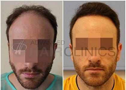 Όλα όσα πρέπει να γνωρίζετε για τη μεταμόσχευση μαλλιών