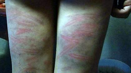 Αδιανόητο: Δάσκαλος μαστίγωσε μαθητή επειδή έκανε λάθος σε άσκηση στα μαθηματικά