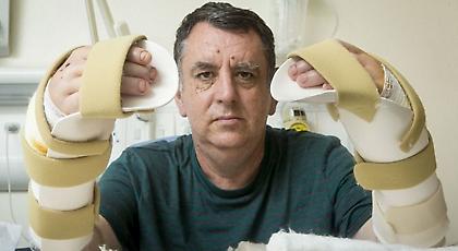 Επιτυχημένη η πρώτη διπλή μεταμόσχευση χεριού στη Μεγάλη Βρετανία (pics)