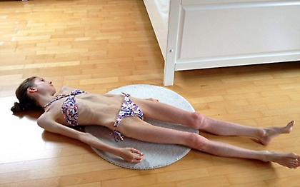 Η 19χρονη που επιβίωσε με 39 θερμίδες τη μέρα αποκαλύπτει πώς σώθηκε