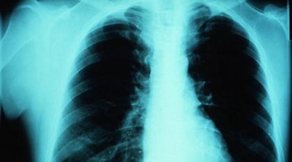 Ελπίδες για ασθενείς με άσθμα από νέο φάρμακο