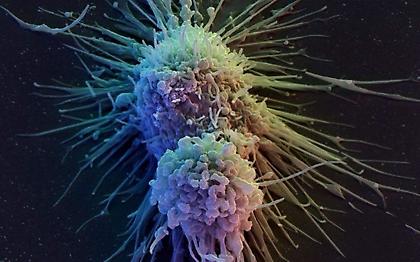 Κυριότερη αιτία θανάτου σε 12 χώρες ο καρκίνος