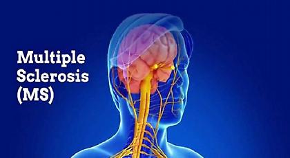 Νέα δεδομένα για τους πάσχοντες από Πολλαπλή Σκλήρυνση κατά πλάκας