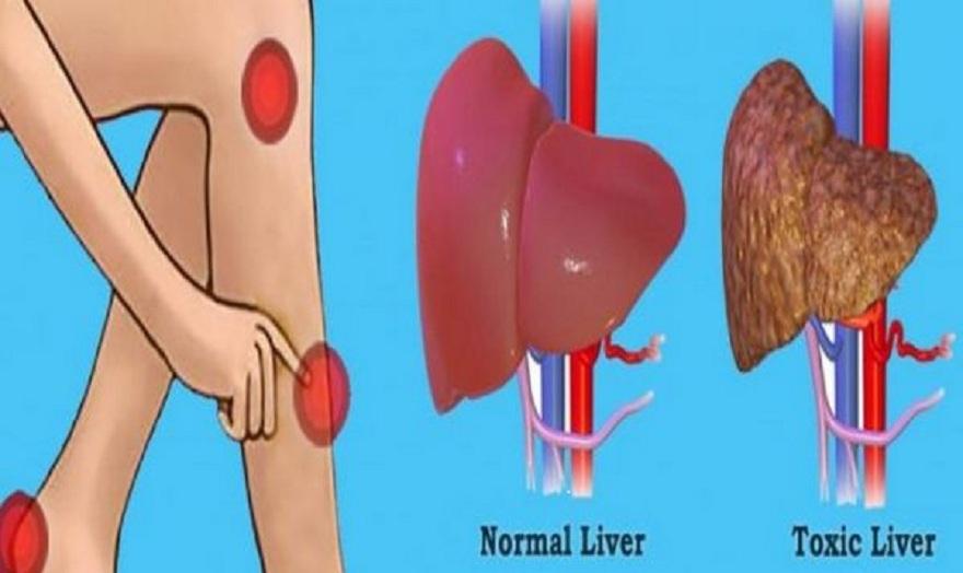 Τα 20 σημάδια που δείχνουν ότι το συκώτι σας είναι γεμάτο τοξίνες και σας κάνει να παίρνετε κιλά