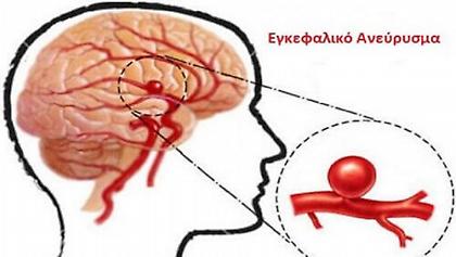 Ανεύρυσμα στο κεφάλι: Πώς θα αναγνωρίσετε τη ρήξη πριν να είναι πολύ αργά!