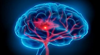 Εγκεφαλικό: Προσοχή στα συμπτώματα – Πώς μπορείτε να το προλάβετε