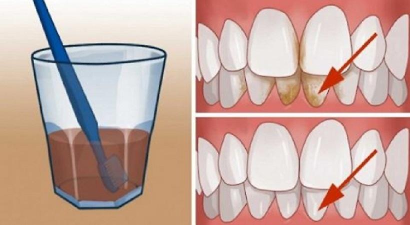 Αυτοί είναι οι φυσικοί τρόποι για να απαλλαγείτε από την πλάκα σε χρόνο μηδέν!