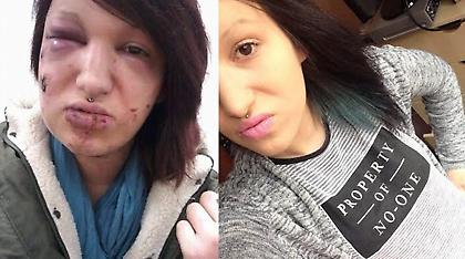 «Χάνιμπαλ» της κατασπάραξε το πρόσωπο για να μην την ξανακοιτάξει άλλος άντρας!