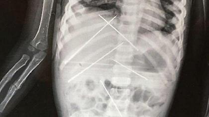 Τελετή μαύρη μαγείας σε 3χρονη - Της έβαλαν επτά βελόνες