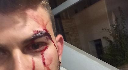 Ιταλοί ξυλοκόπησαν νεαρό Ελληνα στην Πάρο για το ντύσιμό του -Τι καταγγέλλει το θύμα