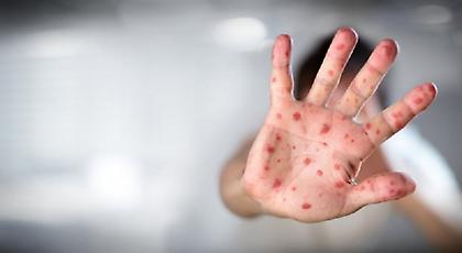 Νεκρή από ιλαρά μία 16χρονη που δεν είχε εμβολιαστεί στη Μασσαλία