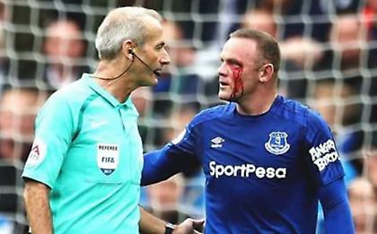 Σοκάρουν οι φωτογραφίες του Ρούνεϊ μετά από αγκωνιά που δέχτηκε (pics)