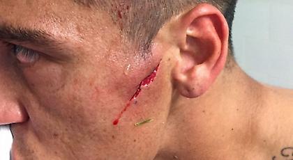 Ανατριχιαστικός τραυματισμός στο πρόσωπο για αμυντικό στη Χιλή