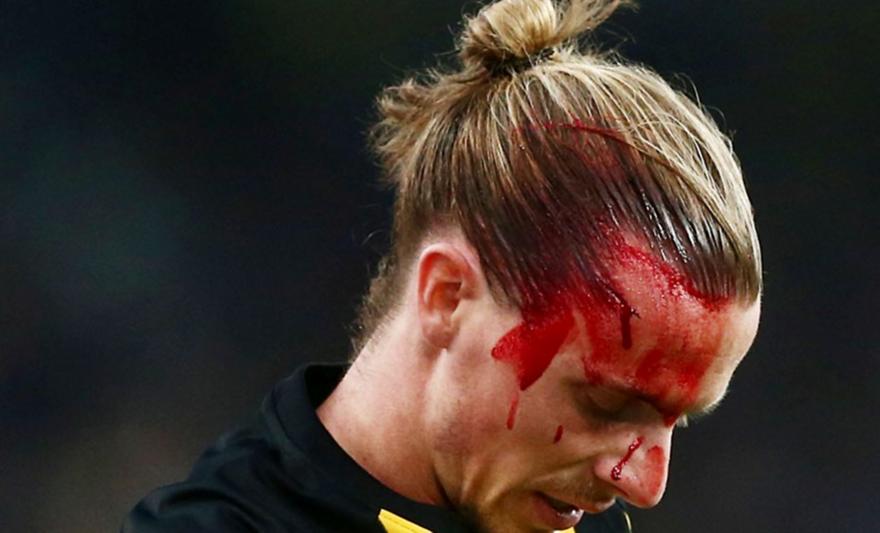 Μάτωσε το πρόσωπο του Χουλτ (pics)