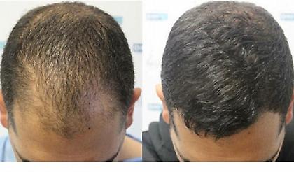 Τριχόπτωση; Πάρε τα μέτρα σου, έλα στην DHI