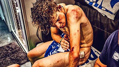 Ποδηλάτης του Tour de France παρουσιάζει τις πληγές του (pic)