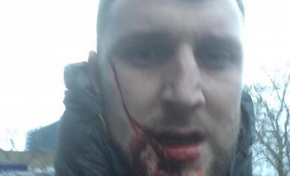 H ανατριχιαστική μαχαιριά στο πρόσωπο οπαδού της Έβερτον (pic)