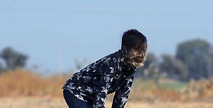 Αγόρι «λυκάνθρωπος»: Η σπάνια ασθένεια από την οποία πάσχει ένα παιδί