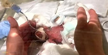 Θαύμα στην Ιαπωνία: Νεογέννητο γεννήθηκε 268 γραμμάρια και έζησε