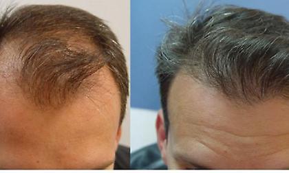 Εμφύτευση μαλλιών: Δερματολόγοι 70 χωρών καλούν τον κόσμο να μην κάνει στην Τουρκία