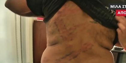 Με κατάγματα και σχεδόν χωρίς αυτί ο άνδρας που ξυλοκοπήθηκε στα Εξάρχεια