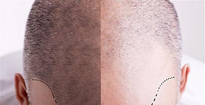 Τουρκία: «Βιομηχανία» με τζίρο 1 δισ. η μεταμόσχευση μαλλιών