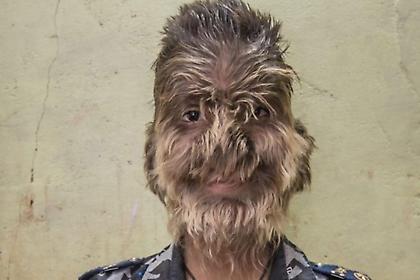 Ένα αγόρι «λυκάνθρωπος» ζει στην Ινδία (vid)