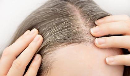 Άγχος: Επιστήμονες επιβεβαιώνουν πως ασπρίζουν απότομα τα μαλλιά και αποκαλύπτουν την αιτία