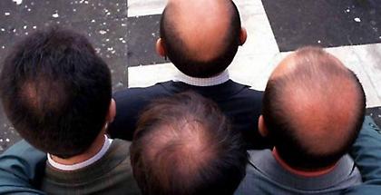 Μην το κάνεις ποτέ: Οι 2 πιο γελοίοι τρόποι να κρύψεις την φαλάκρα σου